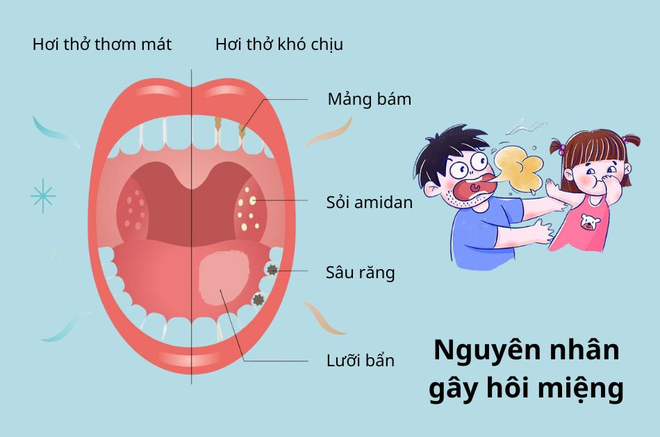 Nguyên nhân gây ra hôi miệng